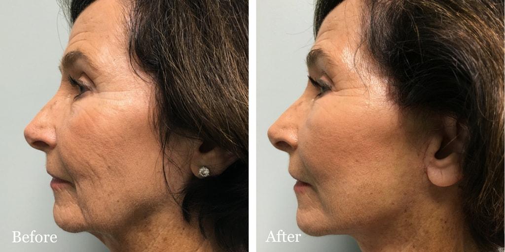 The Palm Beach Center for Facial Plastic Surgery (Jean-Paul Azzi, MD) facelift result — Jupiter, FL