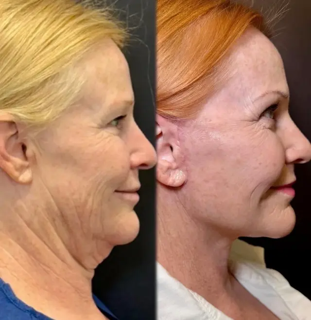 Deep Plane Facelift result at Skin and Face Phoenix in Phoenix, AZ