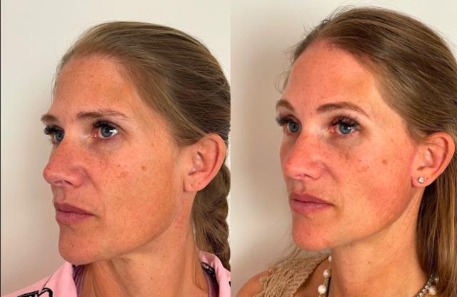 Brow Lift result at Skin and Face Phoenix in Phoenix, AZ