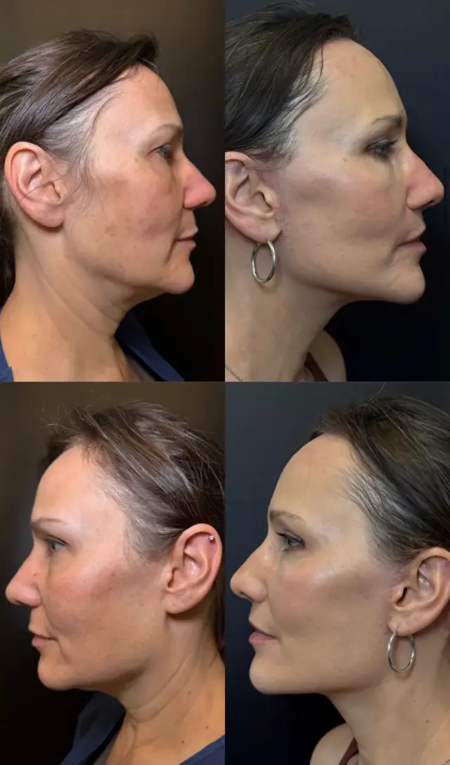 Deep Plane Facelift result at Skin and Face Phoenix in Phoenix, AZ