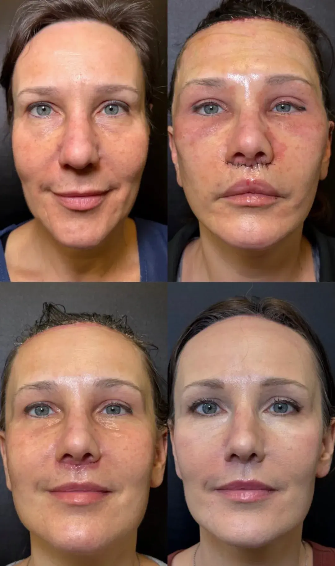 Skin and Face Phoenix lip lift result — Phoenix, AZ