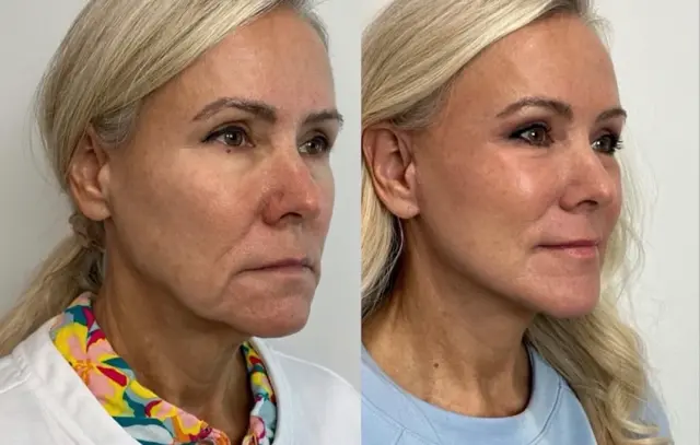 Deep Plane Facelift result at Skin and Face Phoenix in Phoenix, AZ