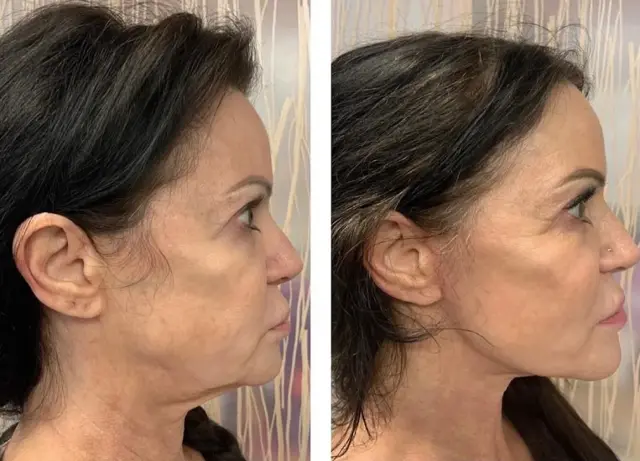 Deep Plane Facelift result at Skin and Face Phoenix in Phoenix, AZ