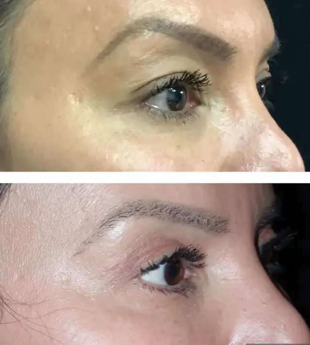Blepharoplasty result at Skin and Face Phoenix in Phoenix, AZ