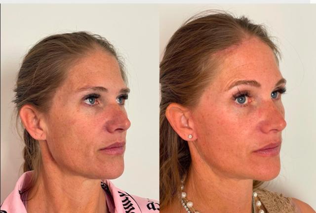 Brow Lift result at Skin and Face Phoenix in Phoenix, AZ