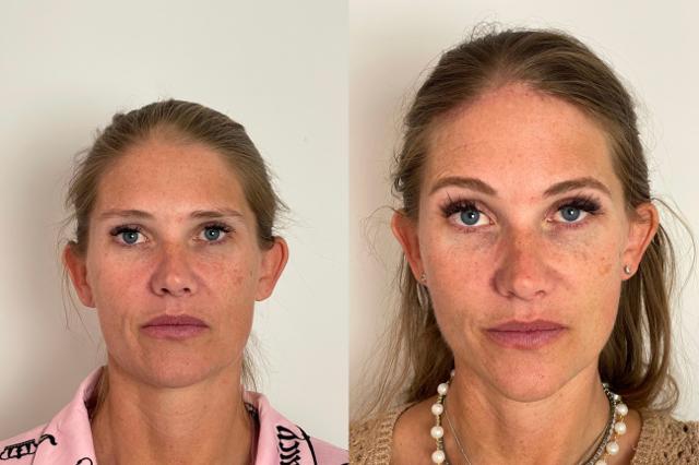 Brow Lift result at Skin and Face Phoenix in Phoenix, AZ