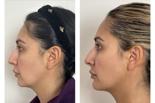 Functional Rhinoplasty result at Skin and Face Phoenix in Phoenix, AZ