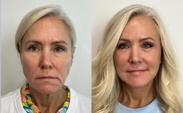 Deep Plane Facelift result at Skin and Face Phoenix in Phoenix, AZ