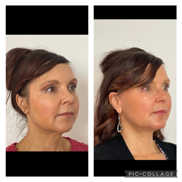 Brow Lift result at Skin and Face Phoenix in Phoenix, AZ