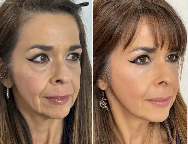 Chin Implant result at Skin and Face Phoenix in Phoenix, AZ