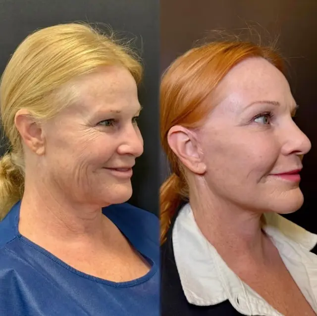 Deep Plane Facelift result at Skin and Face Phoenix in Phoenix, AZ