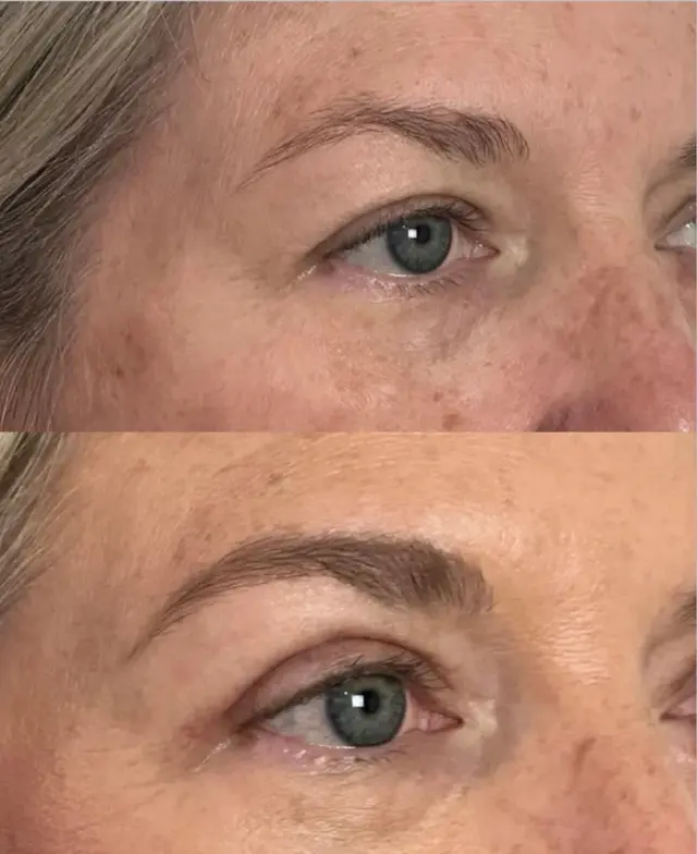 Blepharoplasty result at Skin and Face Phoenix in Phoenix, AZ