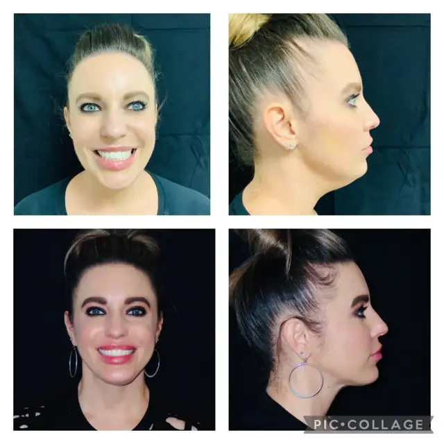 Chin Implant result at Skin and Face Phoenix in Phoenix, AZ