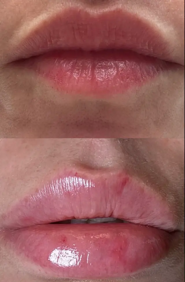 Juvederm result at Skin and Face Phoenix in Phoenix, AZ