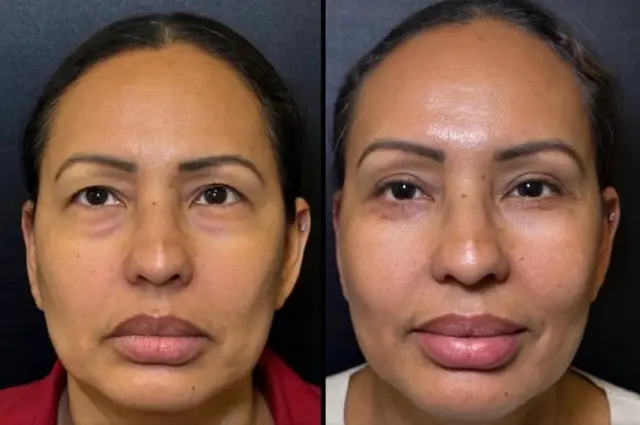Blepharoplasty result at Skin and Face Phoenix in Phoenix, AZ