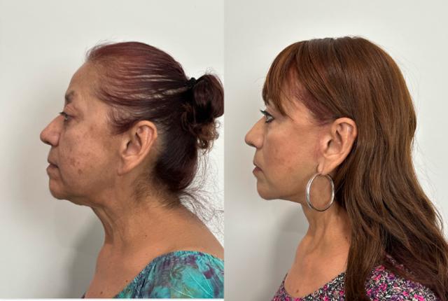 Neck Lift result at Skin and Face Phoenix in Phoenix, AZ