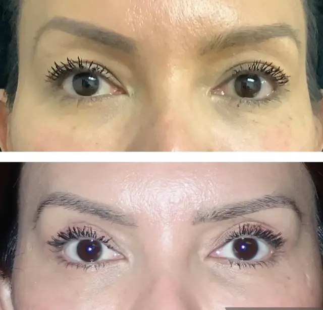 Blepharoplasty result at Skin and Face Phoenix in Phoenix, AZ