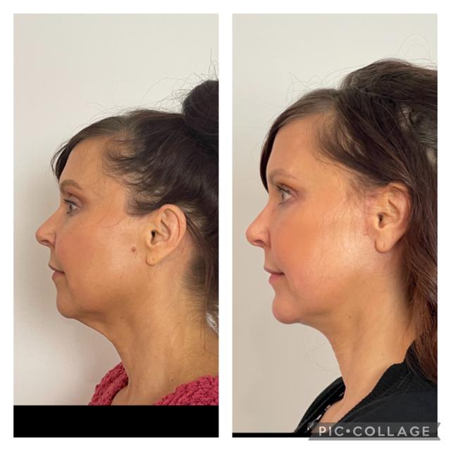 Brow Lift result at Skin and Face Phoenix in Phoenix, AZ