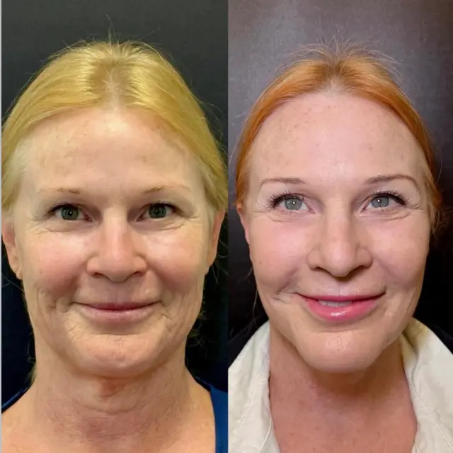 Deep Plane Facelift result at Skin and Face Phoenix in Phoenix, AZ