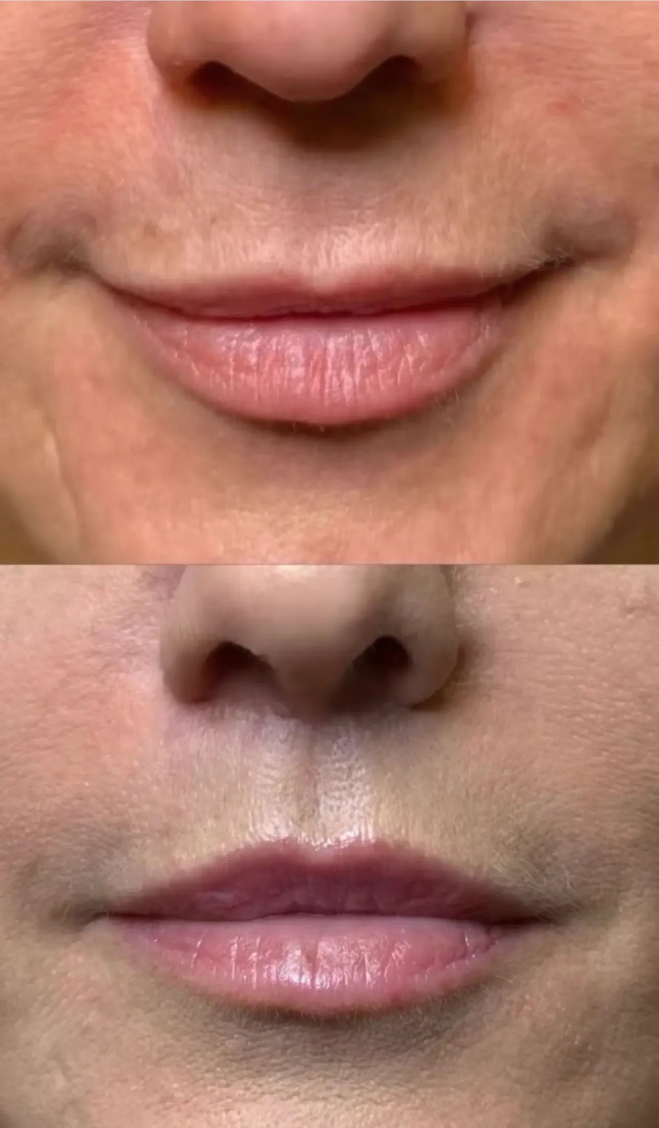 Skin and Face Phoenix lip lift result — Phoenix, AZ
