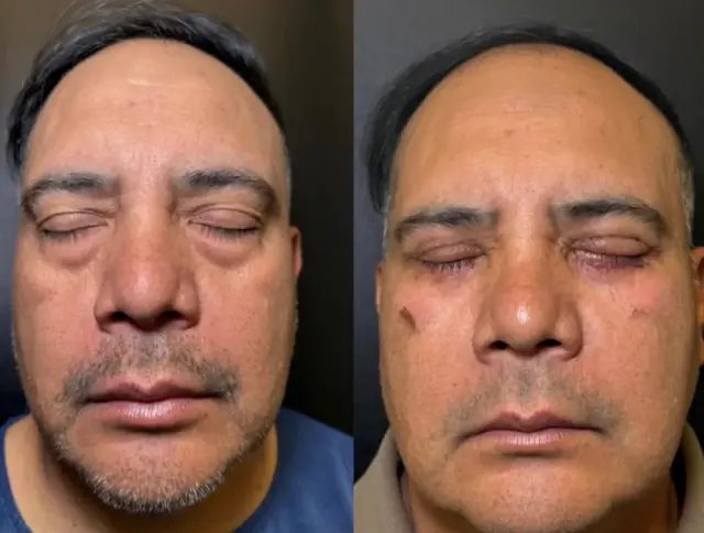 Blepharoplasty result at Skin and Face Phoenix in Phoenix, AZ