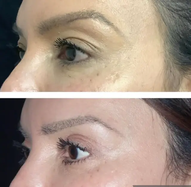 Blepharoplasty result at Skin and Face Phoenix in Phoenix, AZ