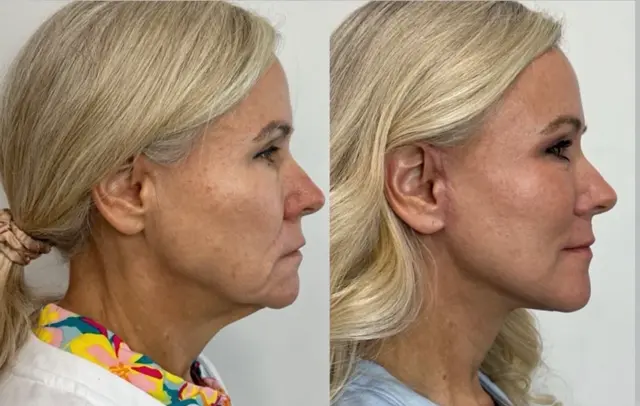 Deep Plane Facelift result at Skin and Face Phoenix in Phoenix, AZ