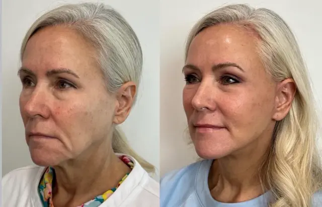 Deep Plane Facelift result at Skin and Face Phoenix in Phoenix, AZ