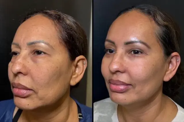 Blepharoplasty result at Skin and Face Phoenix in Phoenix, AZ