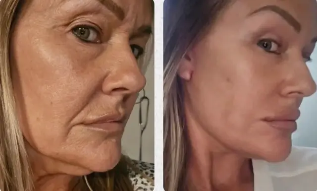 Deep Plane Facelift result at Skin and Face Phoenix in Phoenix, AZ