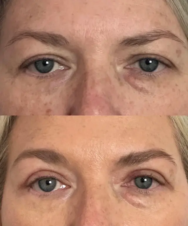 Blepharoplasty result at Skin and Face Phoenix in Phoenix, AZ
