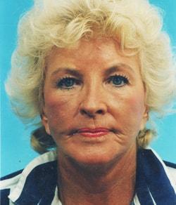 Mazza Plastic Surgery facelift after — Fort Myers, FL