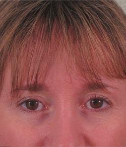 Blepharoplasty after at Mazza Plastic Surgery in Fort Myers, FL