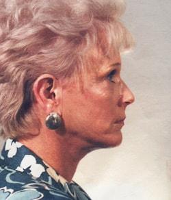 Mazza Plastic Surgery facelift after — Fort Myers, FL