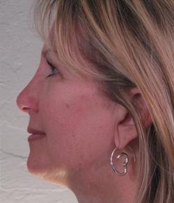 Mazza Plastic Surgery rhinoplasty after — Fort Myers, FL