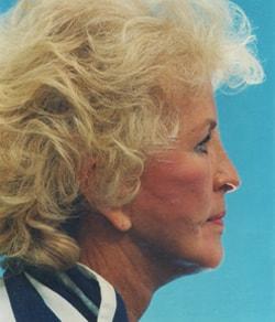 Mazza Plastic Surgery facelift after — Fort Myers, FL