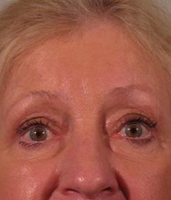 Mazza Plastic Surgery blepharoplasty after — Fort Myers, FL