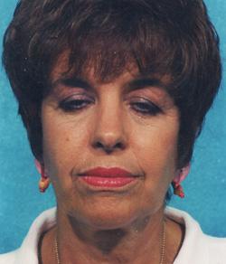 Facelift before at Mazza Plastic Surgery in Fort Myers, FL