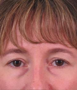 Blepharoplasty before at Mazza Plastic Surgery in Fort Myers, FL