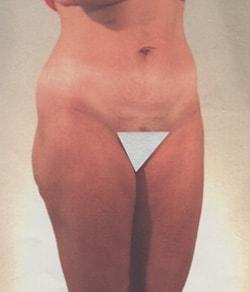 Tummy Tuck after at Mazza Plastic Surgery in Fort Myers, FL
