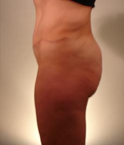 Mazza Plastic Surgery tummy tuck after — Fort Myers, FL