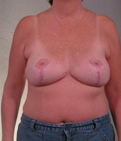 Mazza Plastic Surgery breast reduction after — Fort Myers, FL