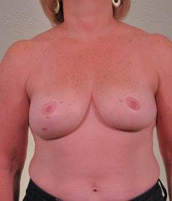 Mazza Plastic Surgery breast reduction after — Fort Myers, FL