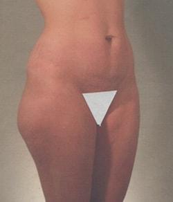 Tummy Tuck before at Mazza Plastic Surgery in Fort Myers, FL