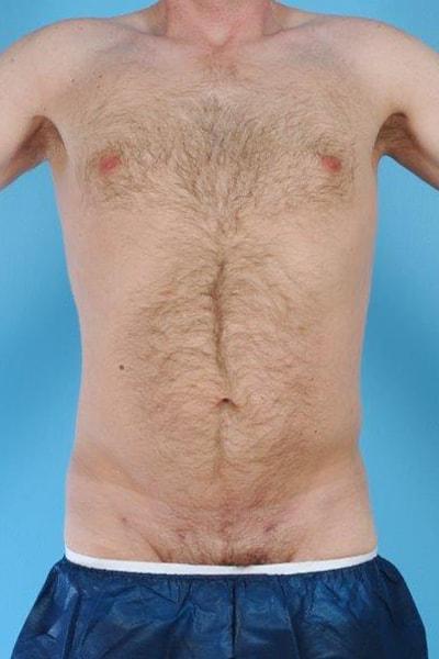 Andrew Lyos, MD liposuction after — Houston, TX