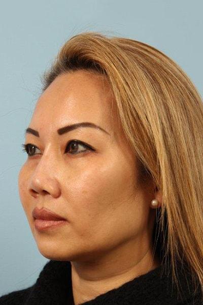 Dermal Fillers after at Andrew Lyos, MD in Houston, TX
