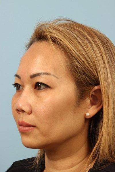 Dermal Fillers before at Andrew Lyos, MD in Houston, TX