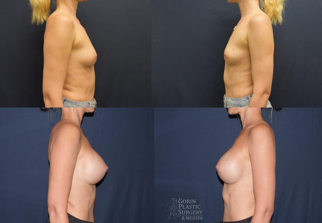 Gorin Plastic Surgery and Med Spa breast augmentation after — Tualatin, OR