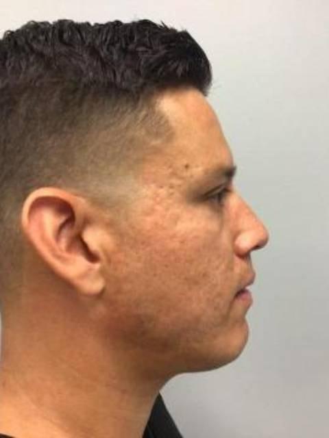 Morpheus8 after at Gorin Plastic Surgery and Med Spa in Tualatin, OR