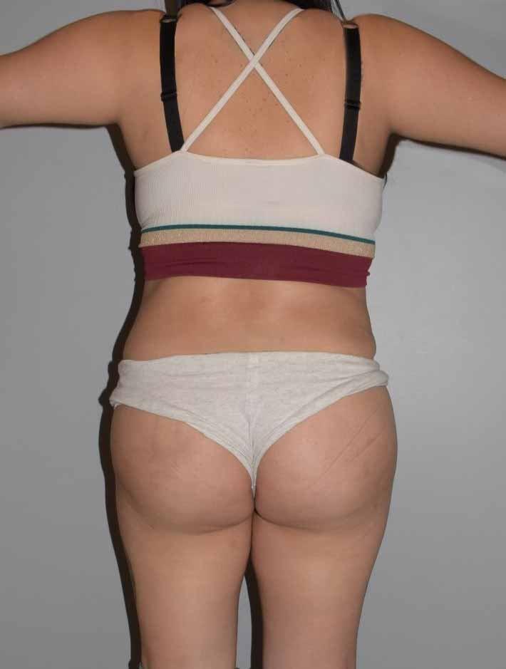 Gorin Plastic Surgery and Med Spa bbl after — Tualatin, OR